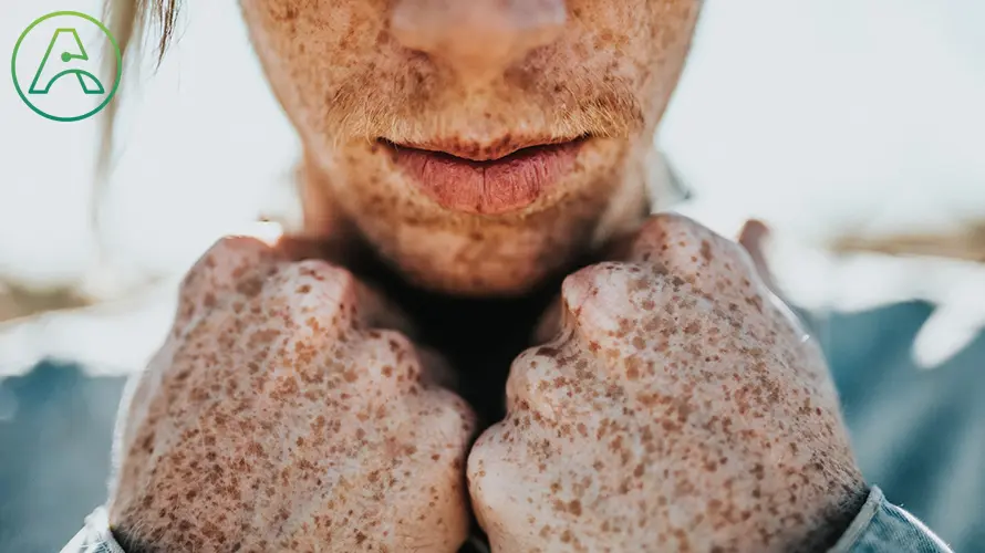 teen with freckles.