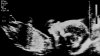 Ultrasound picture of a baby at 20 weeks in pregnancy