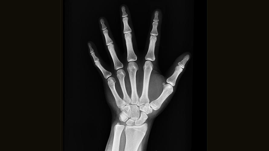 x-ray of a hand showing the skeleton