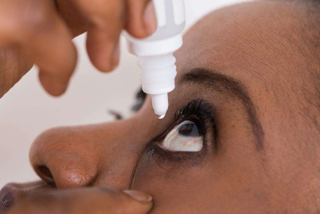  A middle-aged Black woman leans her head back and applies medicated eye drops to one eye.