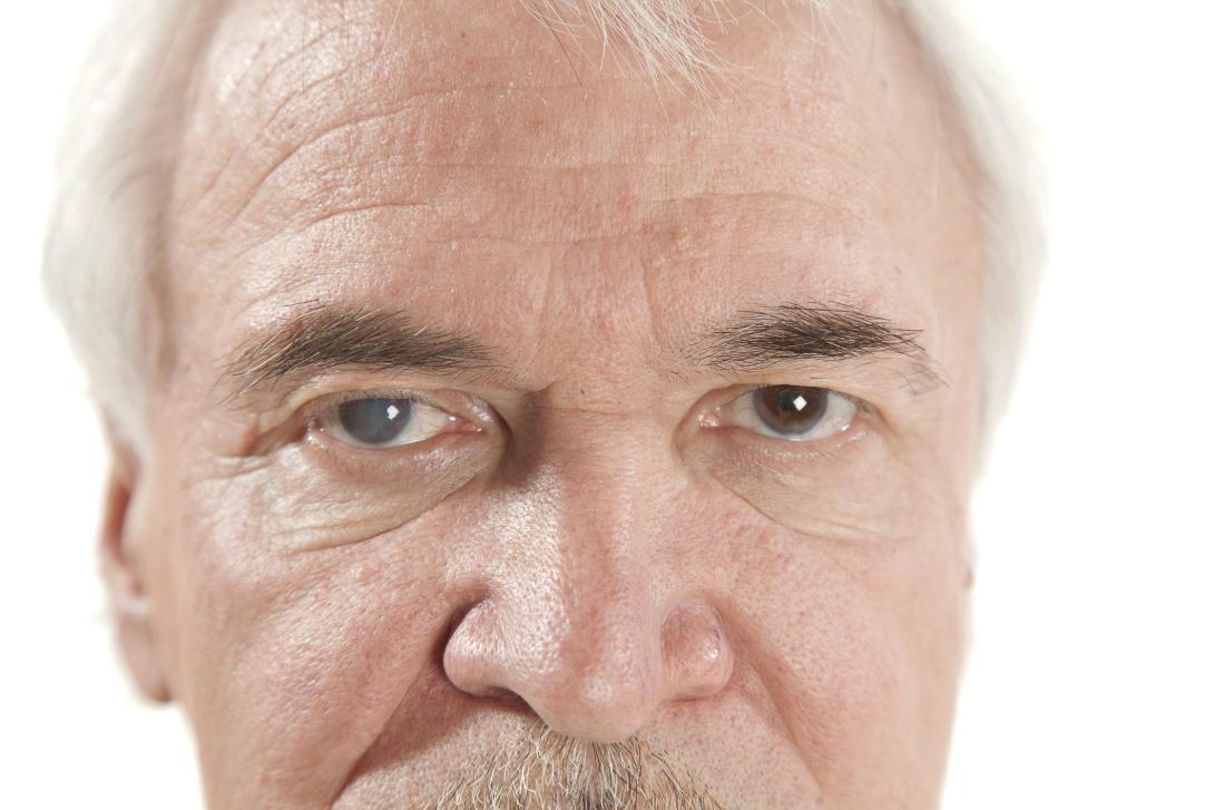  Close up image of the head of a senior white man with white hair and brown eyes. The pupil of one eye is graying, showing signs of glaucoma.