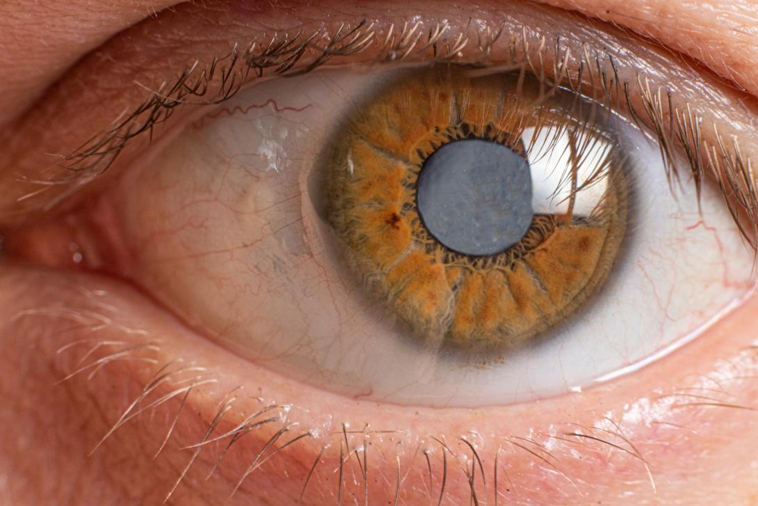 Super close up image of a brown eye with the pupil graying, showing signs of glaucoma.